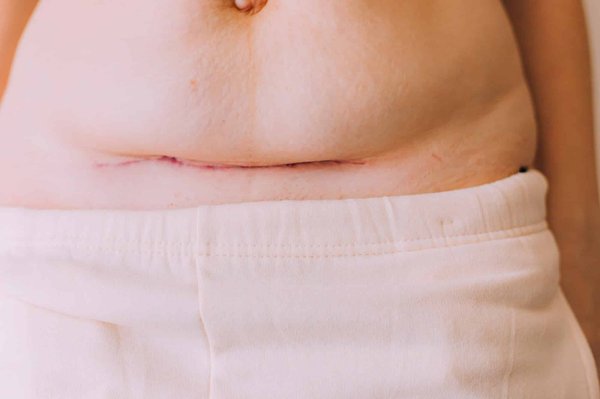 Comment utiliser l'huile de rose musquée pour estomper les cicatrices d'acné ?